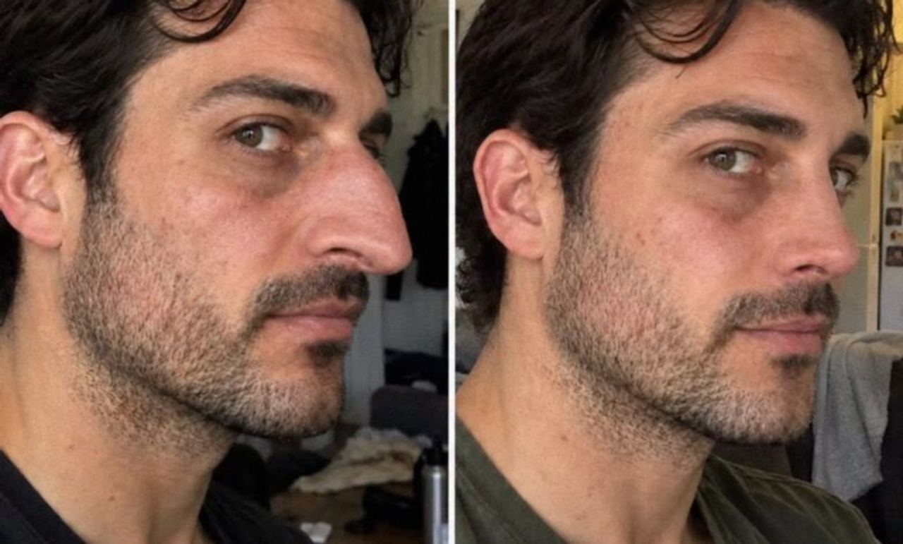 Husband Begged His Wife to Pay for His Nose Job – After Surgery, She Learned Who He Wanted to Look Good For